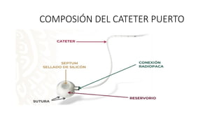 COMPOSIÓN DEL CATETER PUERTO
 