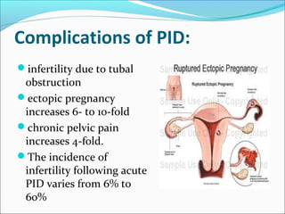 Complications of PID:
infertility due to tubal
obstruction
ectopic pregnancy
increases 6- to 10-fold
chronic pelvic pain
increases 4-fold.
The incidence of
infertility following acute
PID varies from 6% to
60%
 