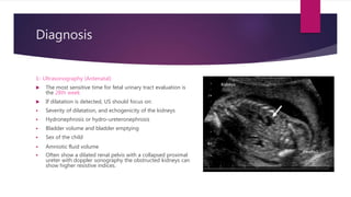 Diagnosis
1- Ultrasonography (Antenatal)
 The most sensitive time for fetal urinary tract evaluation is
the 28th week
 If dilatation is detected, US should focus on:
 Severity of dilatation, and echogenicity of the kidneys
 Hydronephrosis or hydro-ureteronephrosis
 Bladder volume and bladder emptying
 Sex of the child
 Amniotic ﬂuid volume
 Often show a dilated renal pelvis with a collapsed proximal
ureter with doppler sonography the obstructed kidneys can
show higher resistive indices.
 