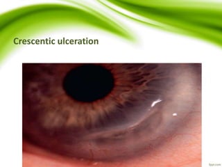 Crescentic ulceration
 