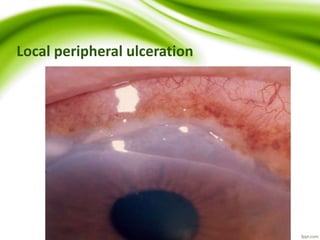 Local peripheral ulceration
 