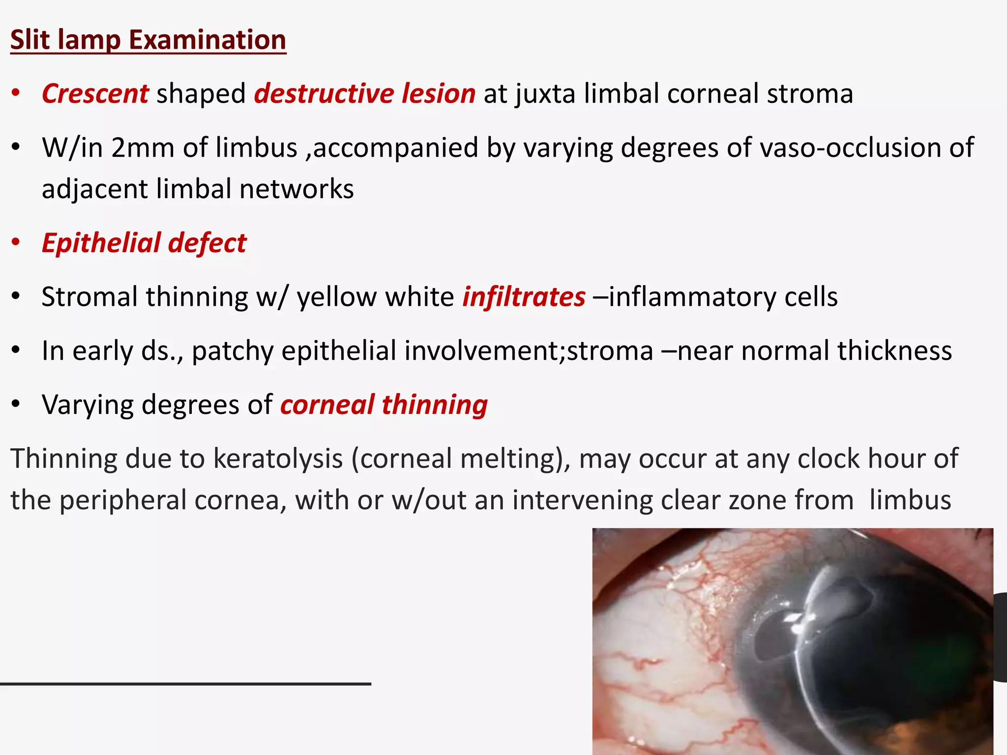 Slit lamp Examination
• Crescent shaped destructive lesion at juxta limbal corneal stroma
• W/in 2mm of limbus ,accompanied by varying degrees of vaso-occlusion of
adjacent limbal networks
• Epithelial defect
• Stromal thinning w/ yellow white infiltrates –inflammatory cells
• In early ds., patchy epithelial involvement;stroma –near normal thickness
• Varying degrees of corneal thinning
Thinning due to keratolysis (corneal melting), may occur at any clock hour of
the peripheral cornea, with or w/out an intervening clear zone from limbus
 