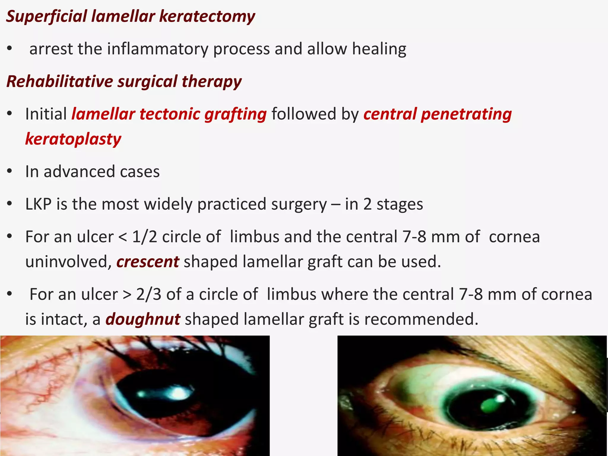 Superficial lamellar keratectomy
• arrest the inflammatory process and allow healing
Rehabilitative surgical therapy
• Initial lamellar tectonic grafting followed by central penetrating
keratoplasty
• In advanced cases
• LKP is the most widely practiced surgery – in 2 stages
• For an ulcer < 1/2 circle of limbus and the central 7-8 mm of cornea
uninvolved, crescent shaped lamellar graft can be used.
• For an ulcer > 2/3 of a circle of limbus where the central 7-8 mm of cornea
is intact, a doughnut shaped lamellar graft is recommended.
 