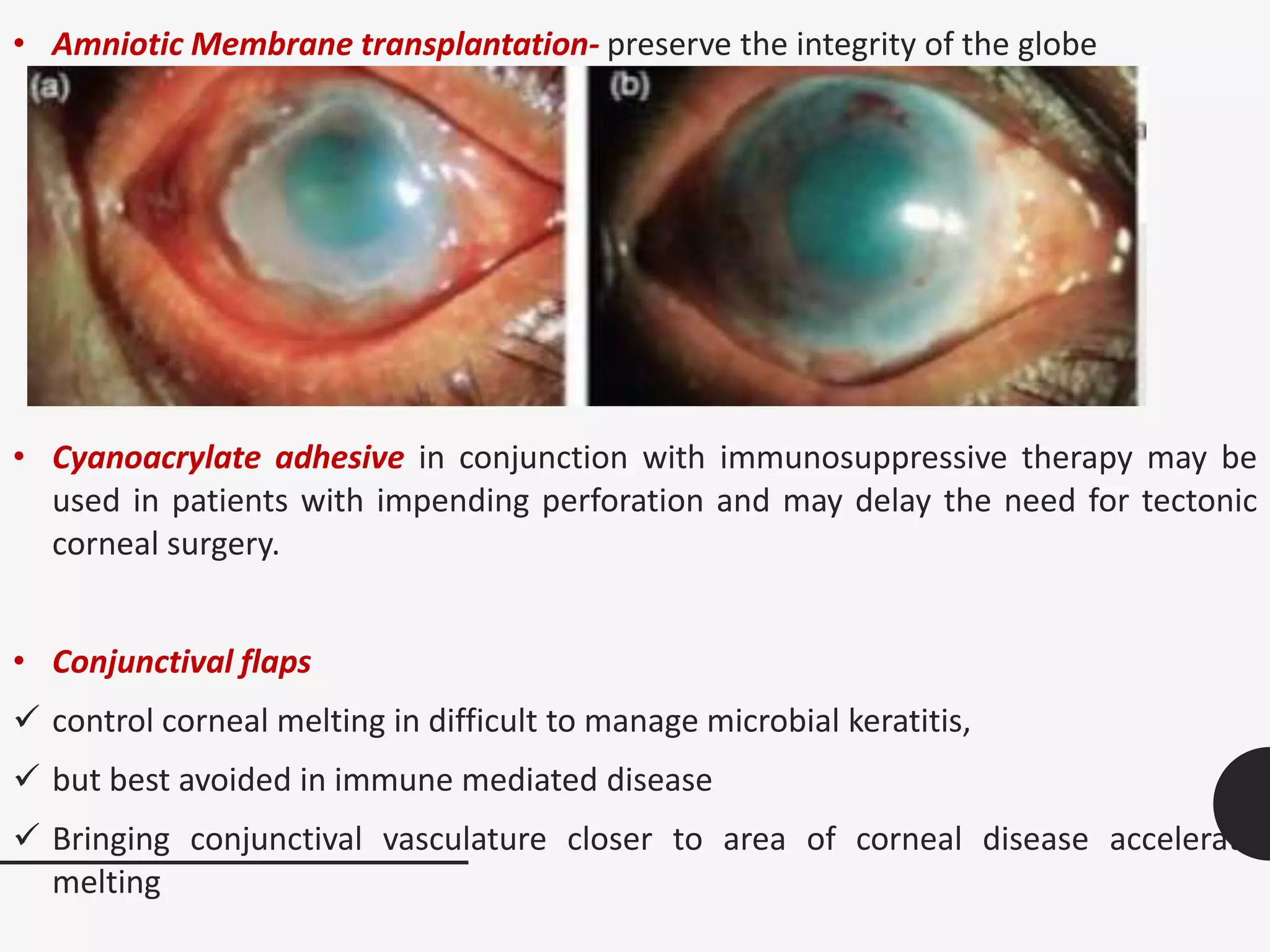 • Amniotic Membrane transplantation- preserve the integrity of the globe
• Cyanoacrylate adhesive in conjunction with immunosuppressive therapy may be
used in patients with impending perforation and may delay the need for tectonic
corneal surgery.
• Conjunctival flaps
 control corneal melting in difficult to manage microbial keratitis,
 but best avoided in immune mediated disease
 Bringing conjunctival vasculature closer to area of corneal disease accelerate
melting
 