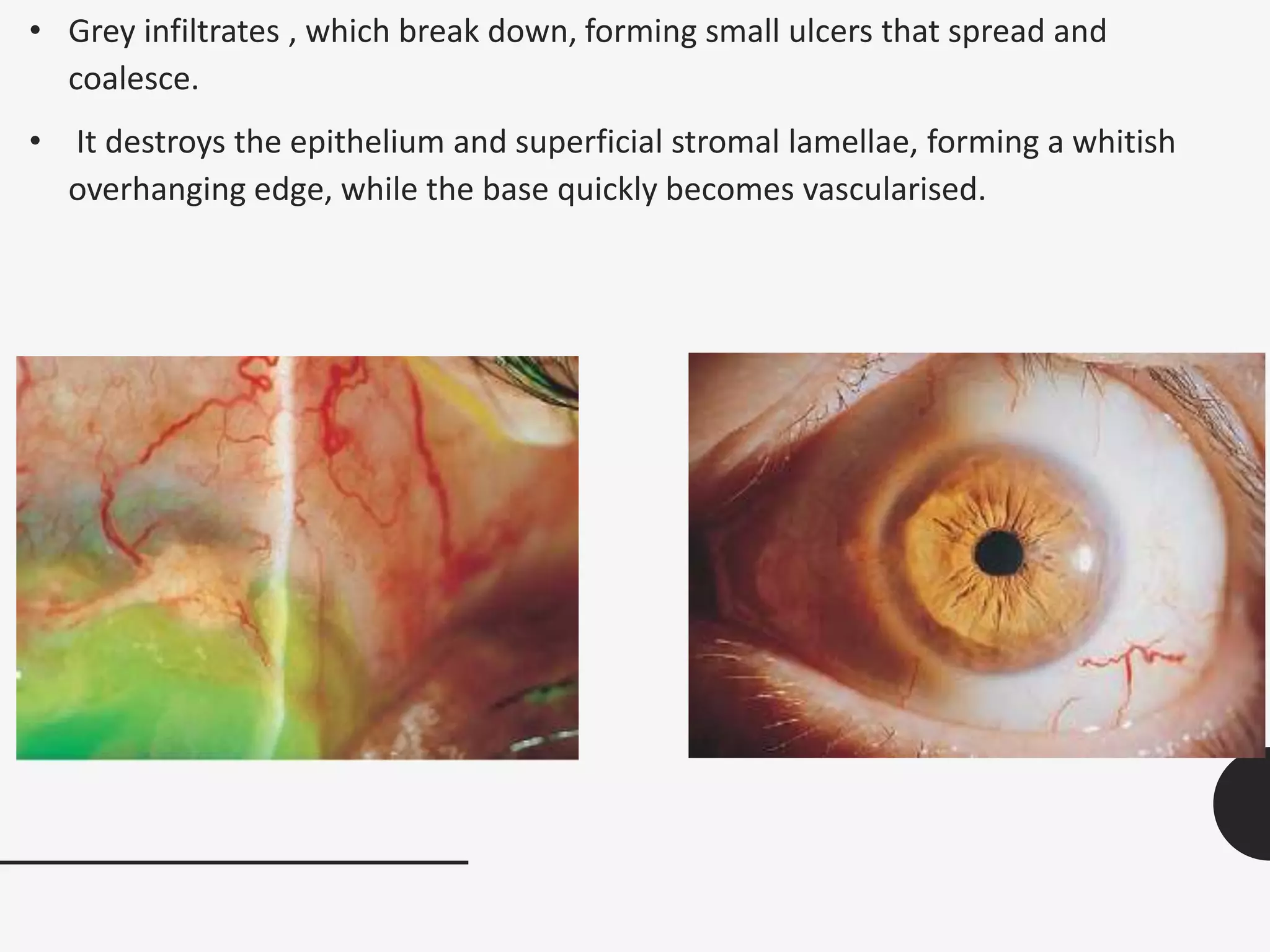 • Grey infiltrates , which break down, forming small ulcers that spread and
coalesce.
• It destroys the epithelium and superficial stromal lamellae, forming a whitish
overhanging edge, while the base quickly becomes vascularised.
 