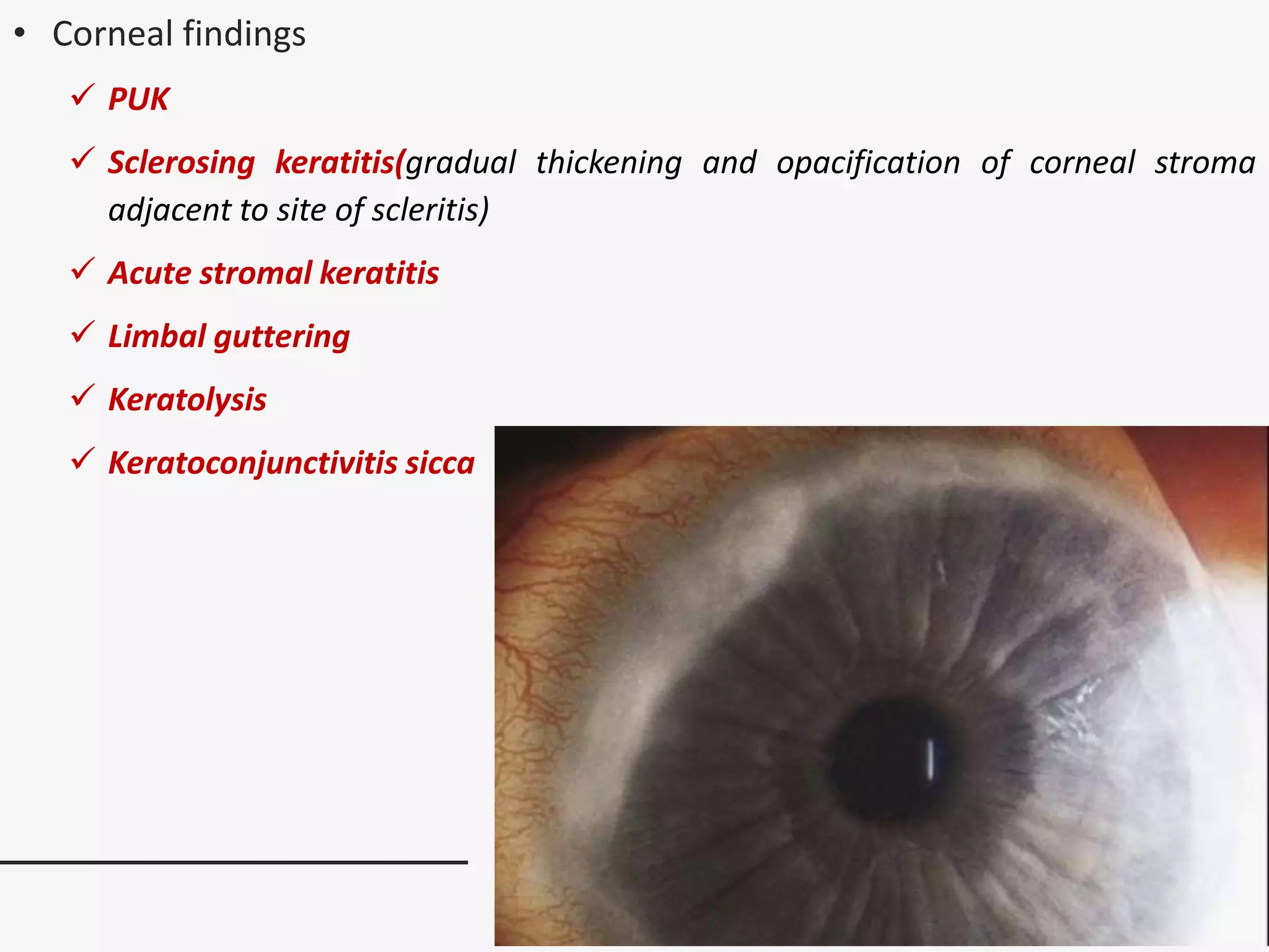 • Corneal findings
 PUK
 Sclerosing keratitis(gradual thickening and opacification of corneal stroma
adjacent to site of scleritis)
 Acute stromal keratitis
 Limbal guttering
 Keratolysis
 Keratoconjunctivitis sicca
 