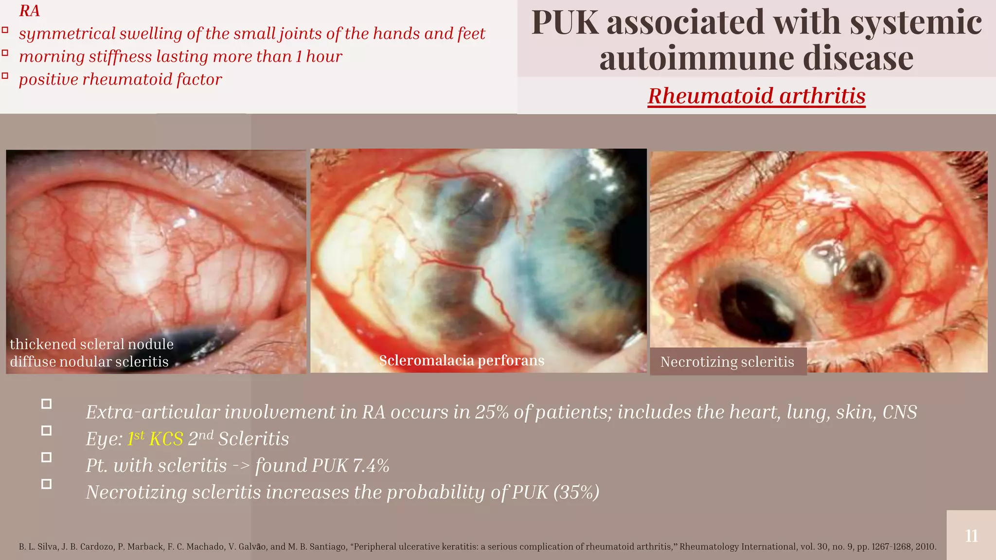 “
11
▫ Extra-articular involvement in RA occurs in 25% of patients; includes the heart, lung, skin, CNS
▫ Eye: 1st KCS 2nd Scleritis
▫ Pt. with scleritis -> found PUK 7.4%
▫ Necrotizing scleritis increases the probability of PUK (35%)
Rheumatoid arthritis
PUK associated with systemic
autoimmune disease
RA
▫ symmetrical swelling of the small joints of the hands and feet
▫ morning stiffness lasting more than 1 hour
▫ positive rheumatoid factor
thickened scleral nodule
diffuse nodular scleritis Necrotizing scleritis
Scleromalacia perforans
B. L. Silva, J. B. Cardozo, P. Marback, F. C. Machado, V. Galvão, and M. B. Santiago, “Peripheral ulcerative keratitis: a serious complication of rheumatoid arthritis,” Rheumatology International, vol. 30, no. 9, pp. 1267-1268, 2010.
 