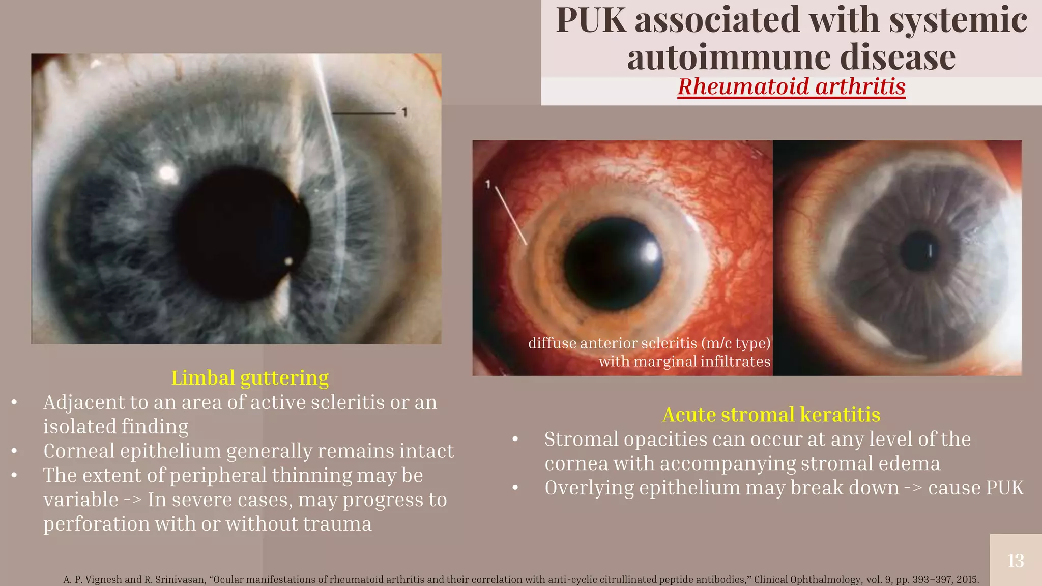 “
13
13
Limbal guttering
• Adjacent to an area of active scleritis or an
isolated finding
• Corneal epithelium generally remains intact
• The extent of peripheral thinning may be
variable -> In severe cases, may progress to
perforation with or without trauma
Acute stromal keratitis
• Stromal opacities can occur at any level of the
cornea with accompanying stromal edema
• Overlying epithelium may break down -> cause PUK
diffuse anterior scleritis (m/c type)
with marginal infiltrates
Rheumatoid arthritis
PUK associated with systemic
autoimmune disease
A. P. Vignesh and R. Srinivasan, “Ocular manifestations of rheumatoid arthritis and their correlation with anti-cyclic citrullinated peptide antibodies,” Clinical Ophthalmology, vol. 9, pp. 393–397, 2015.
 