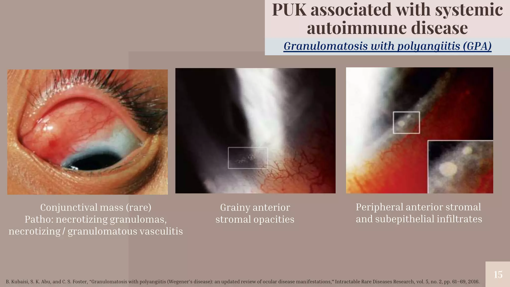 “
15
Granulomatosis with polyangiitis (GPA)
PUK associated with systemic
autoimmune disease
Peripheral anterior stromal
and subepithelial infiltrates
Grainy anterior
stromal opacities
Conjunctival mass (rare)
Patho: necrotizing granulomas,
necrotizing / granulomatous vasculitis
B. Kubaisi, S. K. Abu, and C. S. Foster, “Granulomatosis with polyangiitis (Wegener’s disease): an updated review of ocular disease manifestations,” Intractable Rare Diseases Research, vol. 5, no. 2, pp. 61–69, 2016.
 