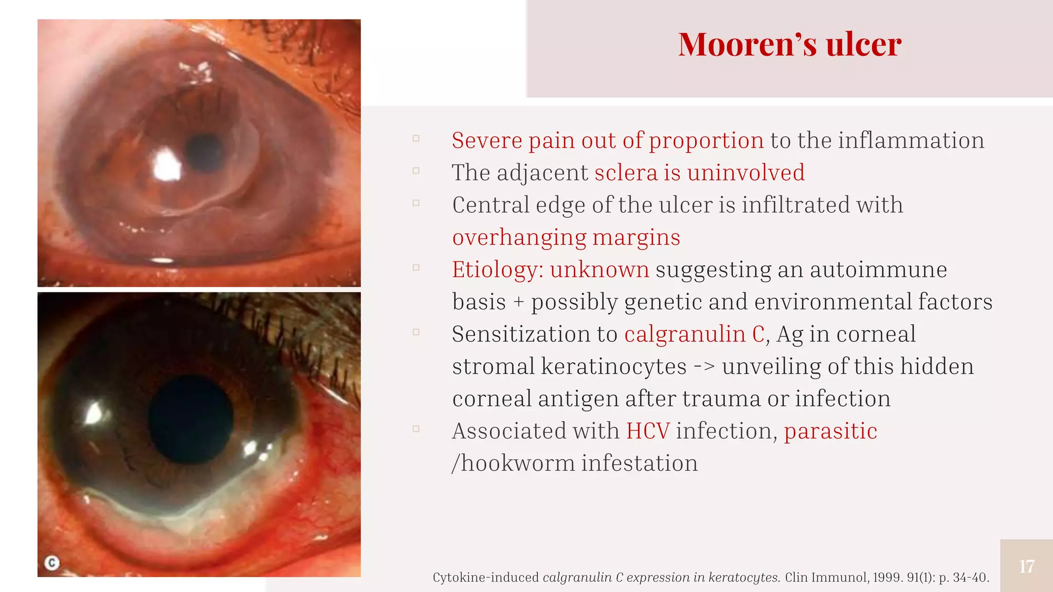 17
Mooren’s ulcer
▫ Severe pain out of proportion to the inflammation
▫ The adjacent sclera is uninvolved
▫ Central edge of the ulcer is infiltrated with
overhanging margins
▫ Etiology: unknown suggesting an autoimmune
basis + possibly genetic and environmental factors
▫ Sensitization to calgranulin C, Ag in corneal
stromal keratinocytes -> unveiling of this hidden
corneal antigen after trauma or infection
▫ Associated with HCV infection, parasitic
/hookworm infestation
Cytokine-induced calgranulin C expression in keratocytes. Clin Immunol, 1999. 91(1): p. 34-40.
 