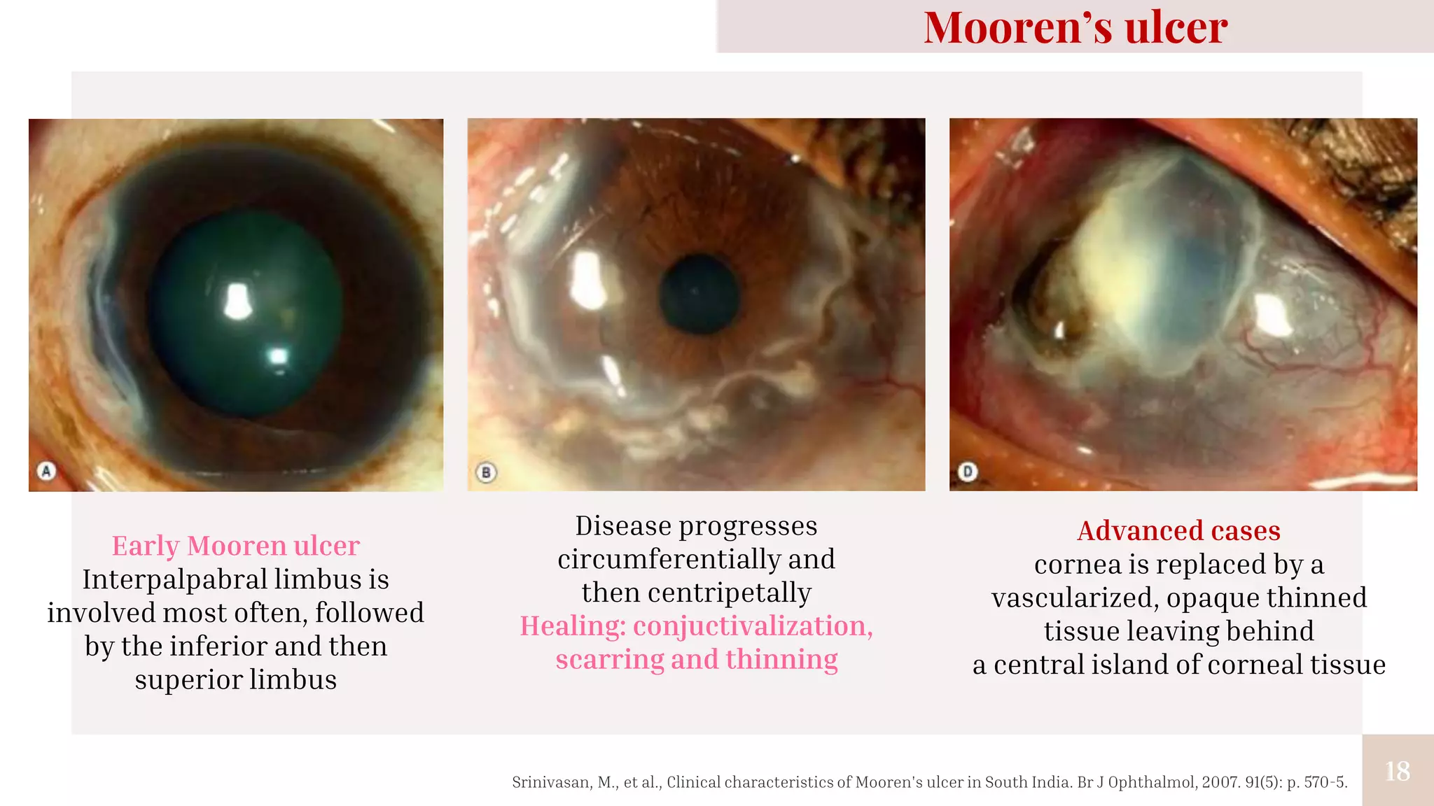 18
Mooren’s ulcer
Early Mooren ulcer
Interpalpabral limbus is
involved most often, followed
by the inferior and then
superior limbus
Disease progresses
circumferentially and
then centripetally
Healing: conjuctivalization,
scarring and thinning
Advanced cases
cornea is replaced by a
vascularized, opaque thinned
tissue leaving behind
a central island of corneal tissue
Srinivasan, M., et al., Clinical characteristics of Mooren's ulcer in South India. Br J Ophthalmol, 2007. 91(5): p. 570-5.
 