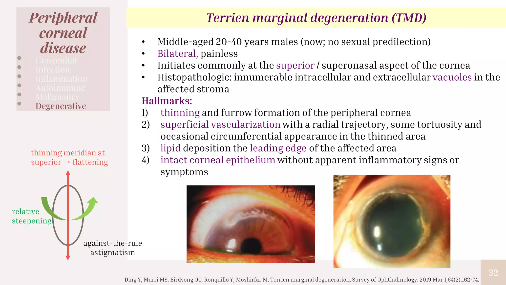 32
Peripheral
corneal
disease
• Congenital
• Infection
• Inflammation
• Autoimmune
• Malignancy
• Degenerative
Terrien marginal degeneration (TMD)
• Middle-aged 20-40 years males (now; no sexual predilection)
• Bilateral, painless
• Initiates commonly at the superior / superonasal aspect of the cornea
• Histopathologic: innumerable intracellular and extracellular vacuoles in the
affected stroma
Hallmarks:
1) thinning and furrow formation of the peripheral cornea
2) superficial vascularization with a radial trajectory, some tortuosity and
occasional circumferential appearance in the thinned area
3) lipid deposition the leading edge of the affected area
4) intact corneal epithelium without apparent inflammatory signs or
symptoms
thinning meridian at
superior -> flattening
relative
steepening
against-the-rule
astigmatism
Ding Y, Murri MS, Birdsong OC, Ronquillo Y, Moshirfar M. Terrien marginal degeneration. Survey of Ophthalmology. 2019 Mar 1;64(2):162-74.
 