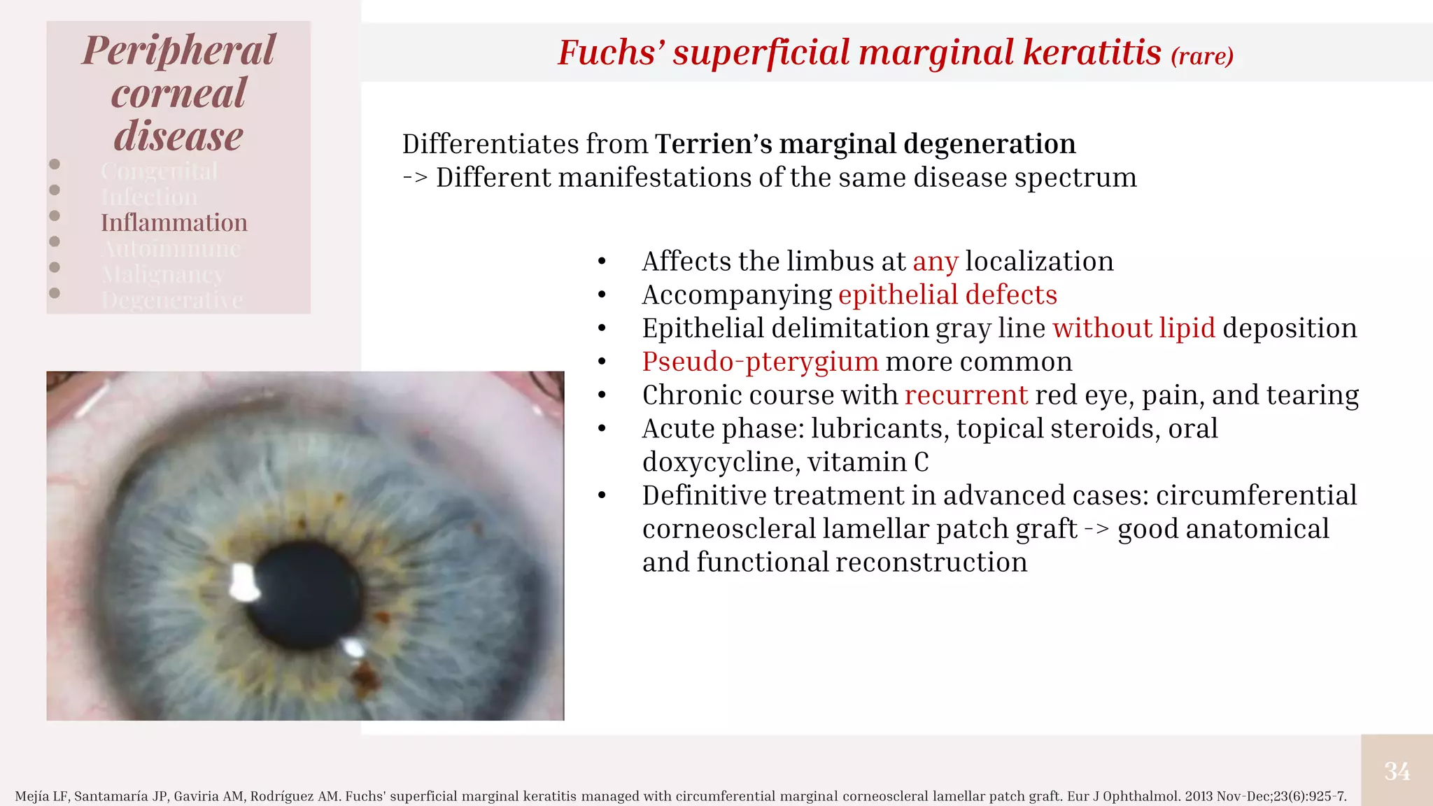 34
Peripheral
corneal
disease
• Congenital
• Infection
• Inflammation
• Autoimmune
• Malignancy
• Degenerative
Fuchs’ superficial marginal keratitis (rare)
Mejía LF, Santamaría JP, Gaviria AM, Rodríguez AM. Fuchs' superficial marginal keratitis managed with circumferential marginal corneoscleral lamellar patch graft. Eur J Ophthalmol. 2013 Nov-Dec;23(6):925-7.
• Affects the limbus at any localization
• Accompanying epithelial defects
• Epithelial delimitation gray line without lipid deposition
• Pseudo-pterygium more common
• Chronic course with recurrent red eye, pain, and tearing
• Acute phase: lubricants, topical steroids, oral
doxycycline, vitamin C
• Definitive treatment in advanced cases: circumferential
corneoscleral lamellar patch graft -> good anatomical
and functional reconstruction
Differentiates from Terrien’s marginal degeneration
-> Different manifestations of the same disease spectrum
 