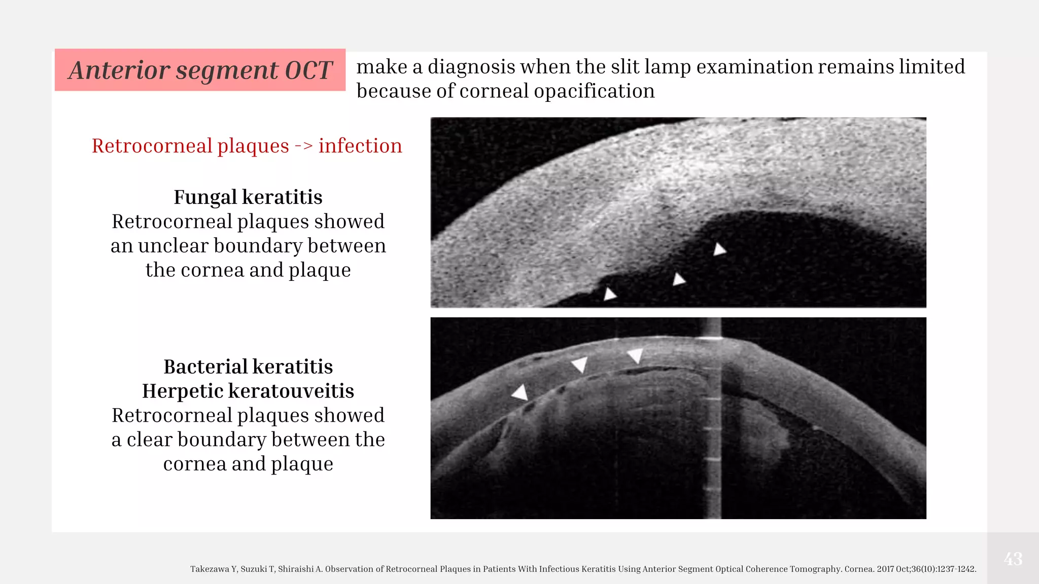 43
Takezawa Y, Suzuki T, Shiraishi A. Observation of Retrocorneal Plaques in Patients With Infectious Keratitis Using Anterior Segment Optical Coherence Tomography. Cornea. 2017 Oct;36(10):1237-1242.
Anterior segment OCT
Fungal keratitis
Retrocorneal plaques showed
an unclear boundary between
the cornea and plaque
Bacterial keratitis
Herpetic keratouveitis
Retrocorneal plaques showed
a clear boundary between the
cornea and plaque
make a diagnosis when the slit lamp examination remains limited
because of corneal opacification
Retrocorneal plaques -> infection
 