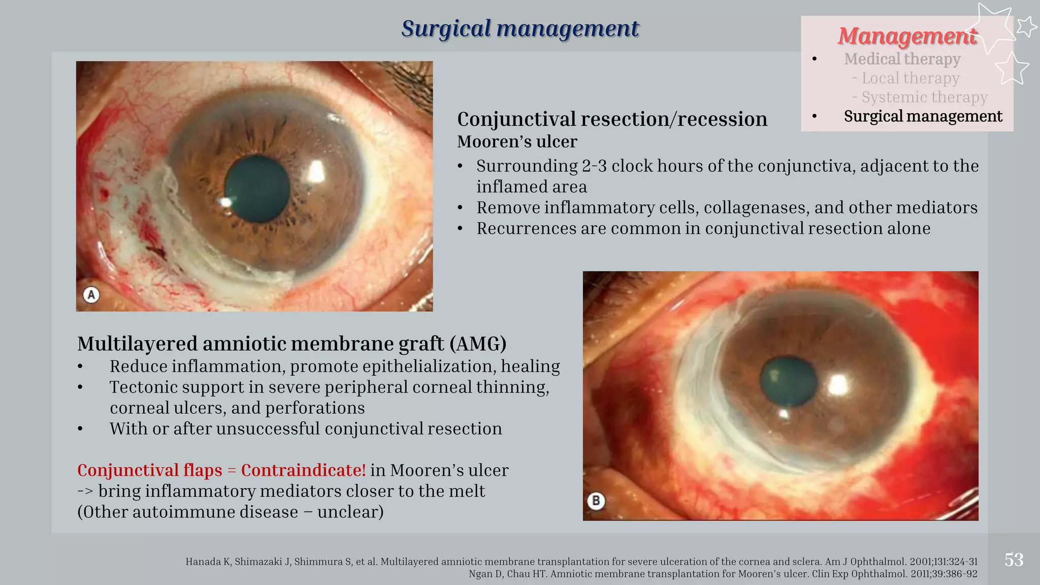 Management
• Medical therapy
- Local therapy
- Systemic therapy
• Surgical management
53
Surgical management
Hanada K, Shimazaki J, Shimmura S, et al. Multilayered amniotic membrane transplantation for severe ulceration of the cornea and sclera. Am J Ophthalmol. 2001;131:324-31
Ngan D, Chau HT. Amniotic membrane transplantation for Mooren’s ulcer. Clin Exp Ophthalmol. 2011;39:386-92
Multilayered amniotic membrane graft (AMG)
• Reduce inflammation, promote epithelialization, healing
• Tectonic support in severe peripheral corneal thinning,
corneal ulcers, and perforations
• With or after unsuccessful conjunctival resection
Conjunctival flaps = Contraindicate! in Mooren’s ulcer
-> bring inflammatory mediators closer to the melt
(Other autoimmune disease – unclear)
• Surrounding 2-3 clock hours of the conjunctiva, adjacent to the
inflamed area
• Remove inflammatory cells, collagenases, and other mediators
• Recurrences are common in conjunctival resection alone
Conjunctival resection/recession
Mooren’s ulcer
 