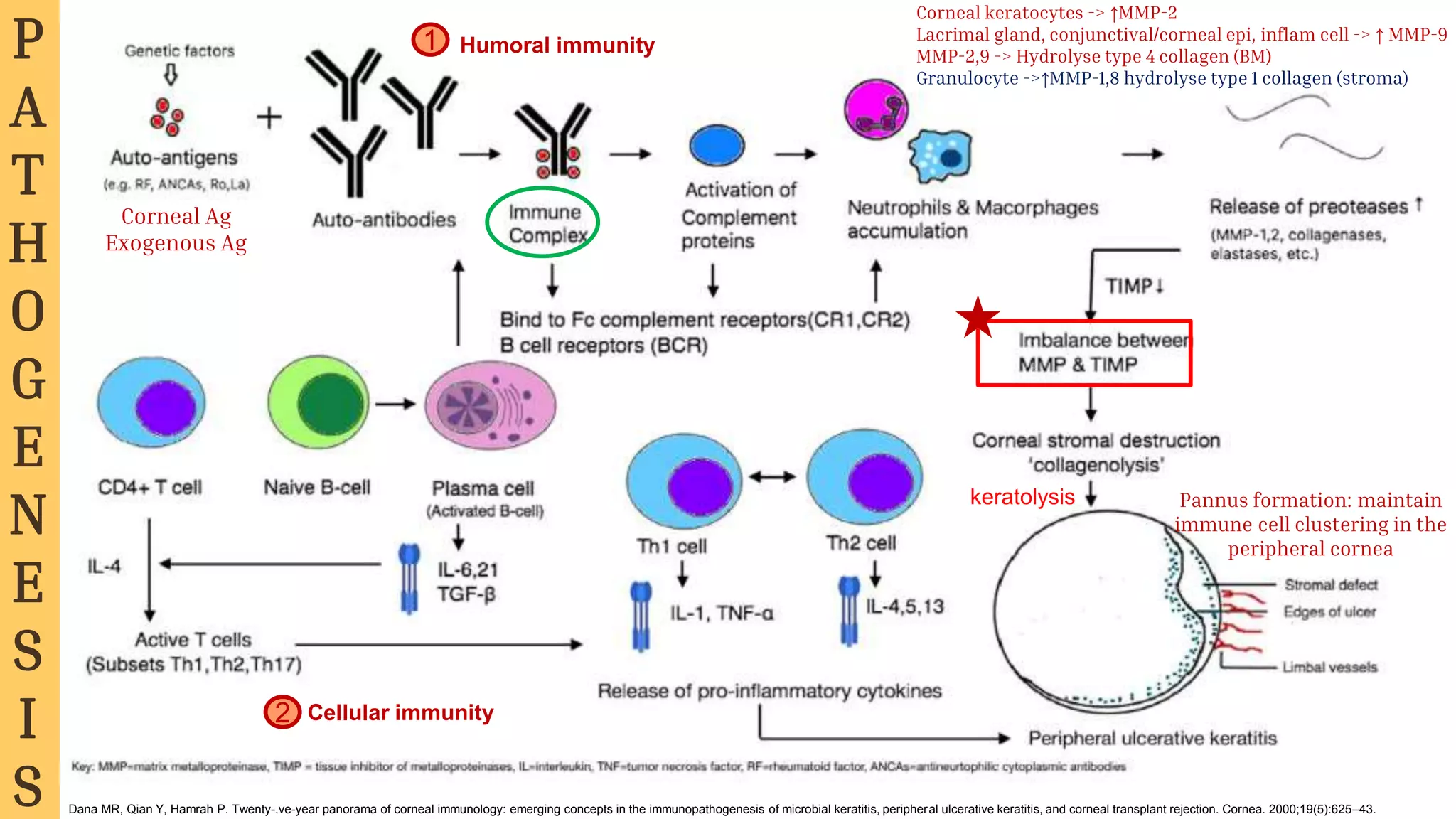 Hello!
I am Jayden Smith
I am here because I love to give
presentations.
You can find me at @username
keratolysis
Corneal Ag
Exogenous Ag
Humoral immunity
Cellular immunity
1
2
Pannus formation: maintain
immune cell clustering in the
peripheral cornea
Dana MR, Qian Y, Hamrah P. Twenty-.ve-year panorama of corneal immunology: emerging concepts in the immunopathogenesis of microbial keratitis, peripheral ulcerative keratitis, and corneal transplant rejection. Cornea. 2000;19(5):625–43.
P
A
T
H
O
G
E
N
E
S
I
S
Corneal keratocytes -> ↑MMP-2
Lacrimal gland, conjunctival/corneal epi, inflam cell -> ↑ MMP-9
MMP-2,9 -> Hydrolyse type 4 collagen (BM)
Granulocyte ->↑MMP-1,8 hydrolyse type 1 collagen (stroma)
 