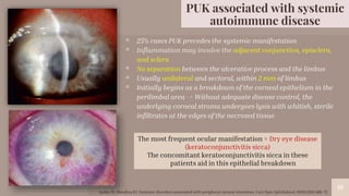 “
10
▫ 25% cases PUK precedes the systemic manifestation
▫ Inflammation may involve the adjacent conjunctiva, episclera,
and sclera
▫ No separation between the ulcerative process and the limbus
▫ Usually unilateral and sectoral, within 2 mm of limbus
▫ Initially begins as a breakdown of the corneal epithelium in the
perilimbal area -> Without adequate disease control, the
underlying corneal stroma undergoes lysis with whitish, sterile
infiltrates at the edges of the necrosed tissue
10
PUK associated with systemic
autoimmune disease
The most frequent ocular manifestation = Dry eye disease
(keratoconjunctivitis sicca)
The concomitant keratoconjunctivitis sicca in these
patients aid in this epithelial breakdown
Ladas JG, Mondino BJ. Systemic disorders associated with peripheral corneal ulceration. Curr Opin Ophthalmol. 2000;11(6):468–71.
 
