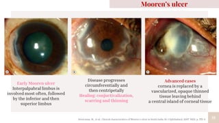 18
Mooren’s ulcer
Early Mooren ulcer
Interpalpabral limbus is
involved most often, followed
by the inferior and then
superior limbus
Disease progresses
circumferentially and
then centripetally
Healing: conjuctivalization,
scarring and thinning
Advanced cases
cornea is replaced by a
vascularized, opaque thinned
tissue leaving behind
a central island of corneal tissue
Srinivasan, M., et al., Clinical characteristics of Mooren's ulcer in South India. Br J Ophthalmol, 2007. 91(5): p. 570-5.
 