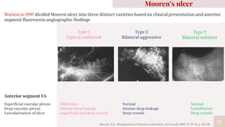 20
Type 1
Typical unilateral
Type 2
Bilateral aggressive
Watson in 1997 divided Mooren ulcer into three distinct varieties based on clinical presentation and anterior
segment fluorescein angiographic findings
Superficial vascular plexus
Deep vascular plexus
Vascularization of ulcer
Normal
Intense deep leakage
Deep vessels
Normal
Vasodilation
Deep vessels
Mooren’s ulcer
Anterior segment FA
Obliterate
Intense deep leakage
superficial and deep vessels
Watson, P.G., Management of Mooren's ulceration. Eye (Lond), 1997. 11 ( Pt 3): p. 349-56.
Type 3
Bilateral indolent
 