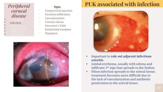 23
PUK associated with infection
• Important to rule out adjacent infectious
scleritis
• Limbal erythema, usually with edema and
infiltrate: 1st sign that spreads to the limbus
• When infection spreads to the scleral tissue,
treatment becomes more difficult due to
the lack of vascularization and antibiotic
penetration in the scleral tissue.
Signs
▫ Conjunctival injection
▫ Purulent infiltration
▫ Vascularization
▫ Corneal edema
▫ Descemet’s folds
▫ Endothelial exudates
▫ Hypopyon
Peripheral
corneal
disease
• Congenital
• Infection
• Inflammation
• Autoimmune
• Malignancy
• Degenerative
 