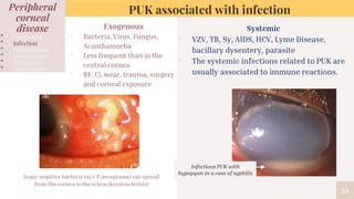 Gram-negative bacteria (m/c P.aeruginosa) can spread
from the cornea to the sclera (keratoscleritis)
24
PUK associated with infection
Systemic
▫ VZV, TB, Sy, AIDS, HCV, Lyme Disease,
bacillary dysentery, parasite
▫ The systemic infections related to PUK are
usually associated to immune reactions.
Infectious PUK with
hypopyon in a case of syphilis
Peripheral
corneal
disease
• Congenital
• Infection
• Inflammation
• Autoimmune
• Malignancy
• Degenerative
Exogenous
▫ Bacteria, Virus, Fungus,
Acanthamoeba
▫ Less frequent than in the
central cornea
▫ RF: CL wear, trauma, surgery
and corneal exposure
 