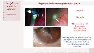 27
Peripheral
corneal
disease
• Congenital
• Infection
• Inflammation
• Autoimmune
• Malignancy
• Degenerative
Phlyctenular keratoconjunctivitis (PKC)
Nodule
Necrosis
Ulcer staining with
fluorescein
R/O infectious
corneal ulcers
Healing: anterior stromal scarring
(triangular in shape with the base
of the triangle at the limbus)
+ superficial vascularization
+thinning
Michelle Steenbakkers. Corneal Phlyctenule in a Steroid Responder. Clinical and Refractive Optometry 28:5, 2017
 