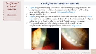 29
Peripheral
corneal
disease
• Congenital
• Infection
• Inflammation
• Autoimmune
• Malignancy
• Degenerative
Staphylococcal marginal keratitis
Thygeson P. Marginal corneal infiltrates and ulcers. Trans Am Acad Ophthalmol Otolaryngol 1947;51:198-209.
• Type III hypersensitivity reaction -> immune complex deposition in the
peripheral cornea -> activate the complement pathway -> attracting
neutrophils to the site -> opacity (catarrhal infiltrate)
• No age predilection
• Sterile peripheral corneal infiltrates separated from the limbus by a clear
zone; circular zone of the cornea (1-2 mm from the limbus may have Ag:Ab
ratio that is conducive to larger, more inflam immune complexes
• Thygeson first reported the frequent association with chronic
conjunctivitis due to Staphylococcus, concurrent blepharitis
 