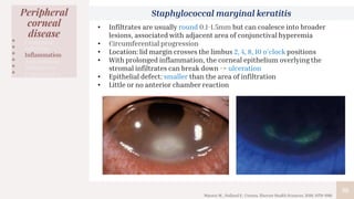 30
Peripheral
corneal
disease
• Congenital
• Infection
• Inflammation
• Autoimmune
• Malignancy
• Degenerative
Staphylococcal marginal keratitis
• Infiltrates are usually round 0.1-1.5mm but can coalesce into broader
lesions, associated with adjacent area of conjunctival hyperemia
• Circumferential progression
• Location: lid margin crosses the limbus 2, 4, 8, 10 o’clock positions
• With prolonged inflammation, the corneal epithelium overlying the
stromal infiltrates can break down -> ulceration
• Epithelial defect: smaller than the area of infiltration
• Little or no anterior chamber reaction
Mannis M., Holland E.: Cornea. Elsevier Health Sciences. 2016; 1079-1081.
 
