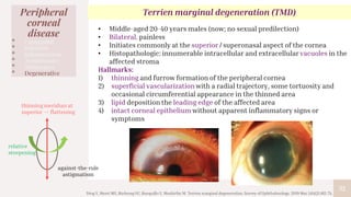32
Peripheral
corneal
disease
• Congenital
• Infection
• Inflammation
• Autoimmune
• Malignancy
• Degenerative
Terrien marginal degeneration (TMD)
• Middle-aged 20-40 years males (now; no sexual predilection)
• Bilateral, painless
• Initiates commonly at the superior / superonasal aspect of the cornea
• Histopathologic: innumerable intracellular and extracellular vacuoles in the
affected stroma
Hallmarks:
1) thinning and furrow formation of the peripheral cornea
2) superficial vascularization with a radial trajectory, some tortuosity and
occasional circumferential appearance in the thinned area
3) lipid deposition the leading edge of the affected area
4) intact corneal epithelium without apparent inflammatory signs or
symptoms
thinning meridian at
superior -> flattening
relative
steepening
against-the-rule
astigmatism
Ding Y, Murri MS, Birdsong OC, Ronquillo Y, Moshirfar M. Terrien marginal degeneration. Survey of Ophthalmology. 2019 Mar 1;64(2):162-74.
 