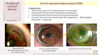 33
Peripheral
corneal
disease
• Congenital
• Infection
• Inflammation
• Autoimmune
• Malignancy
• Degenerative
Terrien marginal degeneration (TMD)
Complication:
• Perforation rate 11.6-15% (spontaneous or traumatic)
• Partial and total Descemet membrane detachments
• Corneal hydrops (intracorneal sac of aqueous humor)
• In some cases, sac can extend under the conjunctiva -> filtering bleb
formation -> hypotony
Superificial NV
Demarcation gray line from
the central cornea
Furrow extend 360 degree
circumferentially
Opacification of central cornea
Ding Y, Murri MS, Birdsong OC, Ronquillo Y, Moshirfar M. Terrien marginal degeneration. Survey of Ophthalmology. 2019 Mar 1;64(2):162-74.
 