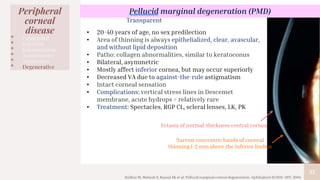 35
Peripheral
corneal
disease
• Congenital
• Infection
• Inflammation
• Autoimmune
• Malignancy
• Degenerative
Pellucid marginal degeneration (PMD)
• 20-40 years of age, no sex predilection
• Area of thinning is always epithelialized, clear, avascular,
and without lipid deposition
• Patho: collagen abnormalities, similar to keratoconus
• Bilateral, asymmetric
• Mostly affect inferior cornea, but may occur superiorly
• Decreased VA due to against-the-rule astigmatism
• Intact corneal sensation
• Complications: vertical stress lines in Descemet
membrane, acute hydrops > relatively rare
• Treatment: Spectacles, RGP CL, scleral lenses, LK, PK
Sridhar M, Mahesh S, Bansal AK et al: Pellucid marginal corneal degeneration. Ophthalmol 111:1102–1107, 2004
Transparent
Narrow concentric bands of corneal
thinning 1-2 mm above the inferior limbus
Ectasia of normal-thickness central cornea
 