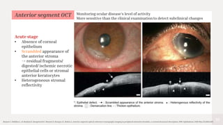 39
Bonnet C, Debillon L, Al-Hashimi S, Hoogewoud F, Monnet D, Bourges JL, Brézin A. Anterior segment optical coherence tomography imaging in peripheral ulcerative keratitis, a corneal structural description. BMC Ophthalmol. 2020 May 25;20(1):205.
Anterior segment OCT
Acute stage
• Absence of corneal
epithelium
• Scrambled appearance of
the anterior stroma
-> residual fragments/
digested/ ischemic necrotic
epithelial cells or stromal
anterior keratocytes
• Heterogeneous stromal
reflectivity
Monitoring ocular disease’s level of activity
More sensitive than the clinical examination to detect subclinical changes
 