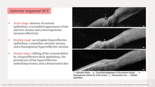 42
Bonnet C, Debillon L, Al-Hashimi S, Hoogewoud F, Monnet D, Bourges JL, Brézin A. Anterior segment optical coherence tomography imaging in peripheral ulcerative keratitis, a corneal structural description. BMC Ophthalmol. 2020 May 25;20(1):205.
Anterior segment OCT
• Acute stage: absence of corneal
epithelium, a scrambled appearance of the
anterior stroma and a heterogeneous
stromal reflectivity
• Healing stage: an irregular hyporeflective
epithelium, a smoother anterior stroma,
and a homogenous hyperreflective stroma
• Healed stage: a filling of the corneal defect
by a hyporeflective thick epithelium, the
persistence of the hyperreflective
underlying stroma, and a demarcation line
 
