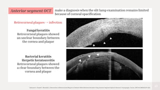 43
Takezawa Y, Suzuki T, Shiraishi A. Observation of Retrocorneal Plaques in Patients With Infectious Keratitis Using Anterior Segment Optical Coherence Tomography. Cornea. 2017 Oct;36(10):1237-1242.
Anterior segment OCT
Fungal keratitis
Retrocorneal plaques showed
an unclear boundary between
the cornea and plaque
Bacterial keratitis
Herpetic keratouveitis
Retrocorneal plaques showed
a clear boundary between the
cornea and plaque
make a diagnosis when the slit lamp examination remains limited
because of corneal opacification
Retrocorneal plaques -> infection
 