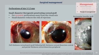 Management
• Medical therapy
- Local therapy
- Systemic therapy
• Surgical management
55
Surgical management
Shi W, Liu M, Gao H, et al. Penetrating keratoplasty with small-diameter and glycerin-cryopreserved grafts for eccentric corneal perforations. Cornea. 2009;28:631-7 111.
Siatiri H, Moghimi S, Malihi M, Khodabande A. Use of sealant (HFG) in corneal perforations. Cornea. 2008;27(9):988-91
Rectangular lamellar graft
Perforations of size 3-5.5 mm
Small-diameter therapeutic penetrating corneal graft
• For eccentric perforations away from the visual axis
• Small diameter reduces the risk of rejection
Full-thickness corneal patch graft following full-thickness corneal dissection central
and partial-thickness scleral dissection peripheral
 