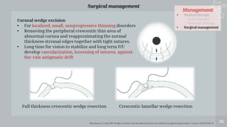 Management
• Medical therapy
- Local therapy
- Systemic therapy
• Surgical management
56
Surgical management
Maccheron LJ, Daya MS. Wedge resection and lamellar dissection for pellucid marginal degeneration. Cornea. 2012;31:708-15
Corneal wedge excision
• For localized, small, nonprogressive thinning disorders
• Removing the peripheral crescentic thin area of
abnormal cornea and reapproximating the normal
thickness stromal edges together with tight sutures.
• Long time for vision to stabilize and long term F/U
develop vascularization, loosening of sutures, against-
the-rule astigmatic drift
Crescentic lamellar wedge resection
Full thickness crescentic wedge resection
 