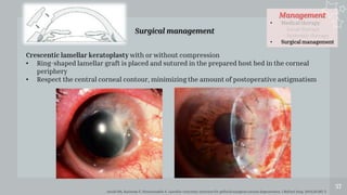 Management
• Medical therapy
- Local therapy
- Systemic therapy
• Surgical management
57
Surgical management
Javadi MA, Karimian F, Hosseinzadeh A. Lamellar crescentic resection for pellucid marginal corneal degeneration. J Refract Surg. 2004;20:162-5
Crescentic lamellar keratoplasty with or without compression
• Ring-shaped lamellar graft is placed and sutured in the prepared host bed in the corneal
periphery
• Respect the central corneal contour, minimizing the amount of postoperative astigmatism
 