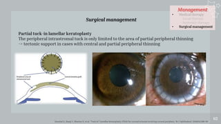 Management
• Medical therapy
- Local therapy
- Systemic therapy
• Surgical management
62
Surgical management
Partial tuck-in lamellar keratoplasty
The peripheral intrastromal tuck is only limited to the area of partial peripheral thinning
-> tectonic support in cases with central and partial peripheral thinning
Kaushal S, Jhanji V, Sharma N, et al. “Tuck In” Lamellar Keratoplasty (TILK) for corneal ectasias involving corneal periphery. Br J Ophthalmol. 2008;92:286-90
 