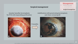 Management
• Medical therapy
- Local therapy
- Systemic therapy
• Surgical management
63
Surgical management
Lim LS, Arundhati A, Tan DT. Sequential therapeutic penetrating keratoplasty with cryopreserved and fresh corneal tissue for severe infectious keratitis: a case-control study. Cornea. 2011;30(7):739–43.
stabilization with penetrating keratoplasty
and clear corneal graft
Annular lamellar keratoplasty
for PUK with impending perforation
9 months
 