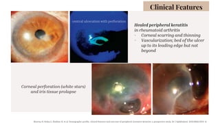 Healed peripheral keratitis
in rheumatoid arthritis
- Corneal scarring and thinning
- Vascularization; bed of the ulcer
up to its leading edge but not
beyond
Corneal perforation (white stars)
and iris tissue prolapse
Clinical Features
central ulceration with perforation
Sharma N, Sinha G, Shekhar H, et al. Demographic profile, clinical features and outcome of peripheral ulcerative keratitis: a prospective study. Br J Ophthalmol. 2015;99(11):1503–8.
 