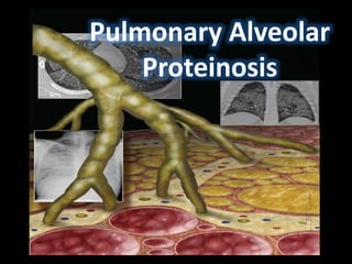 Pulmonary Alveolar 
Proteinosis 
 