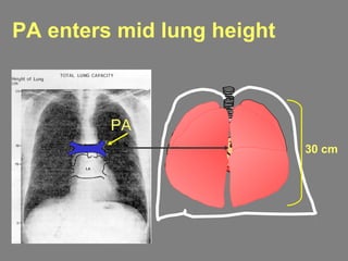PA enters mid lung height
30 cm
PA
 