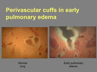 Normal
lung
Early pulmonary
edema
Perivascular cuffs in early
pulmonary edema
cuff
 