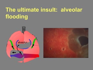 The ultimate insult: alveolar
flooding
alveolus
 