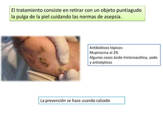 El tratamiento consiste en retirar con un objeto puntiagudo
la pulga de la piel cuidando las normas de asepsia.




                                      Antibióticos tópicos:
                                      Mupirocina al 2%
                                      Algunos casos ácido tricloroacético, yodo
                                      y antisépticos




             La prevención se hace usando calzado
 