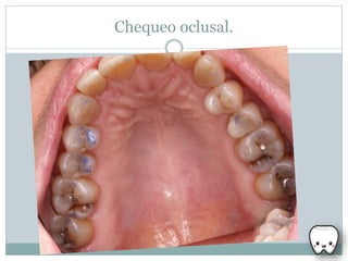 Chequeo oclusal.
 