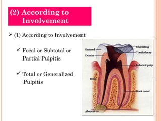 (2) According to
    Involvement
 (1) According to Involvement

    Focal or Subtotal or
     Partial Pulpitis

    Total or Generalized
     Pulpitis
 