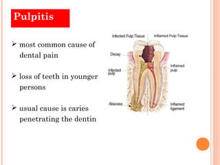 Pulpitis

 most common cause of
  dental pain

 loss of teeth in younger
  persons

 usual cause is caries
  penetrating the dentin
 