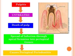 Pulpitis



  UNTREATED



  Death of pulp



 Spread of Infection through
apical foramina into periapical
            tissues



Causes Periapical Periodontitis
 
