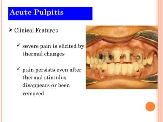Acute Pulpitis

 Clinical Features

    severe pain is elicited by
     thermal changes

    pain persists even after
     thermal stimulus
     disappears or been
     removed
 